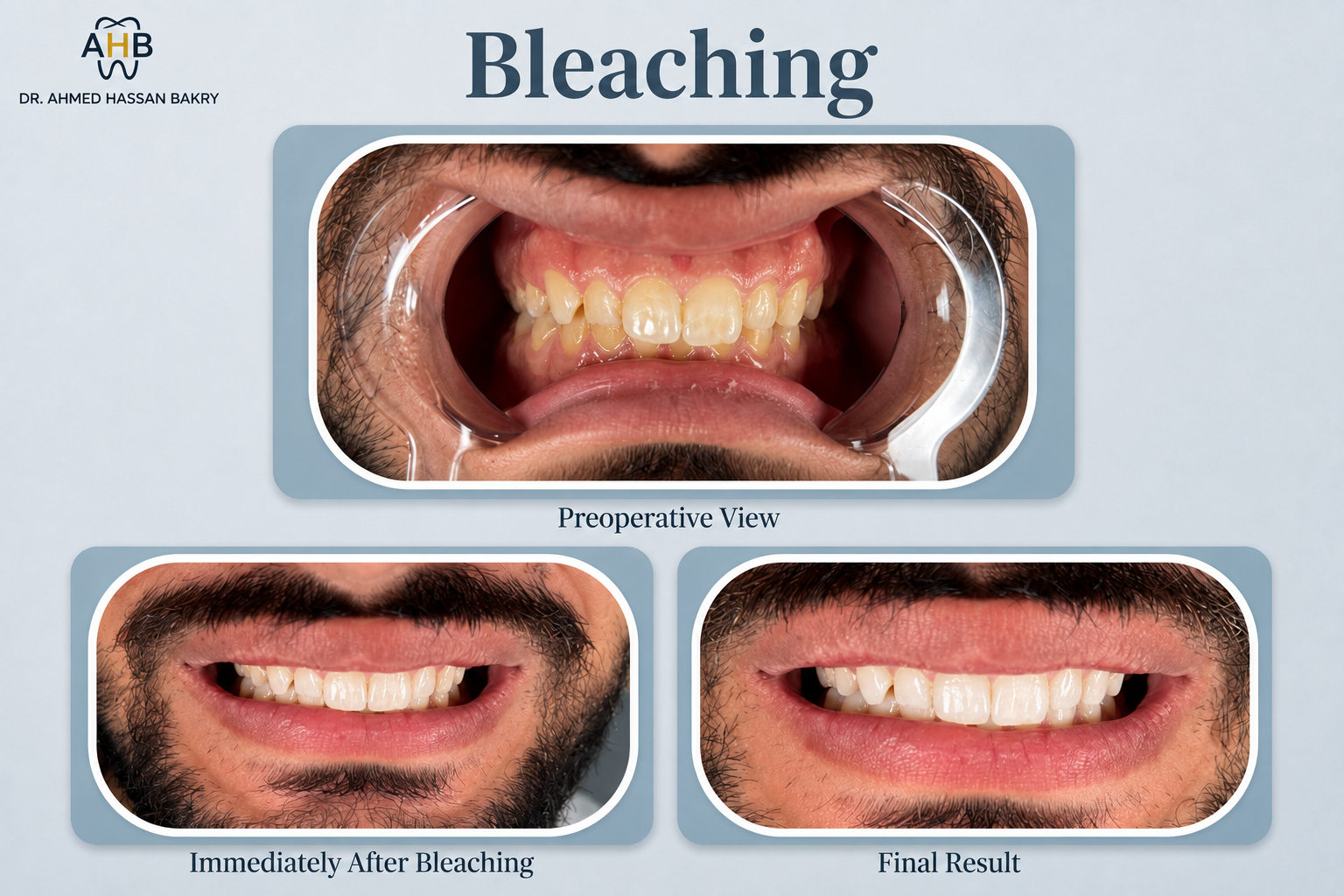 Bleaching